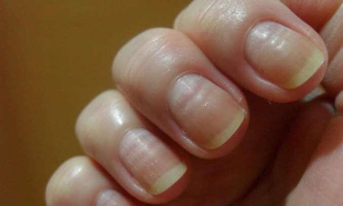 Como-prevenir-y-tratar-las-unas-onduladas